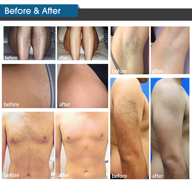 Комментарии Врачей О Диодной Лазерной Эпиляции(图2) Комментарии Врачей О Диодной Лазерной Эпиляции(图2)